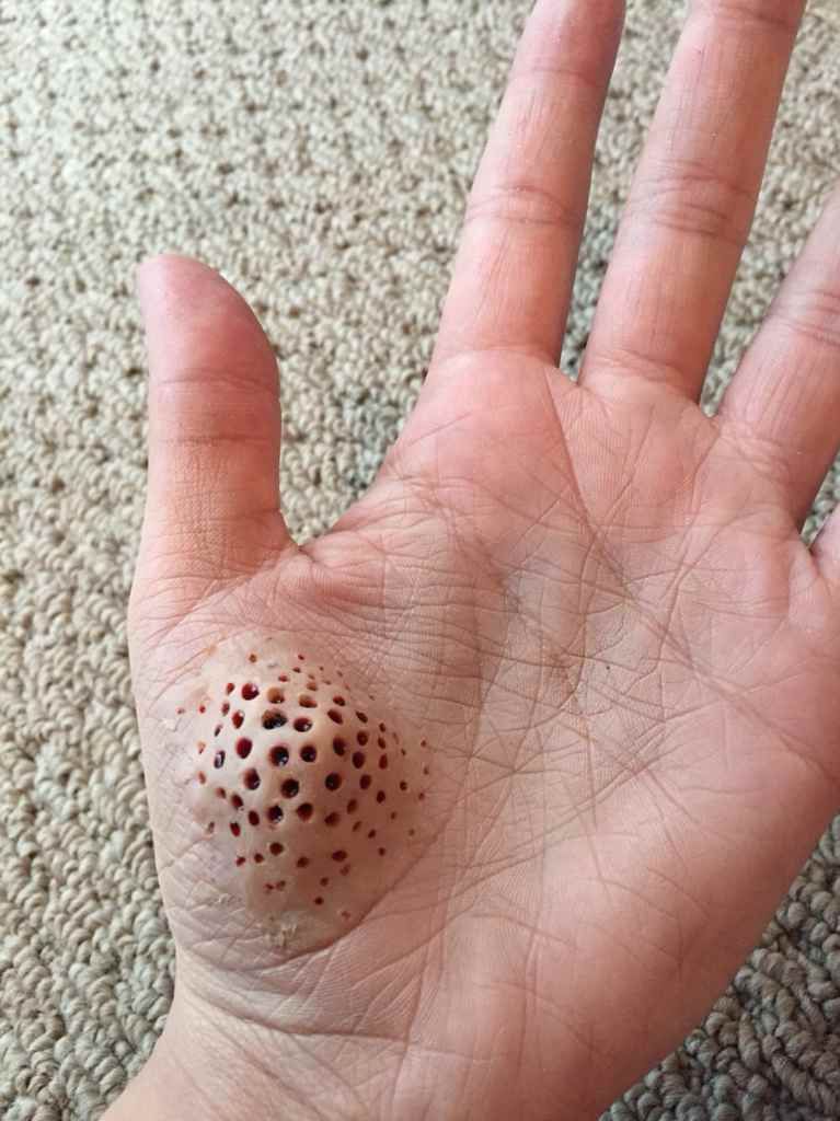 fear of holes in the skin